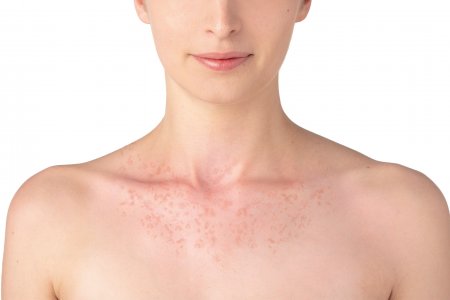 Redness on the chest, one of sun allergies symptoms.