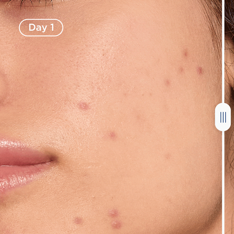 Imagen de una piel con acne