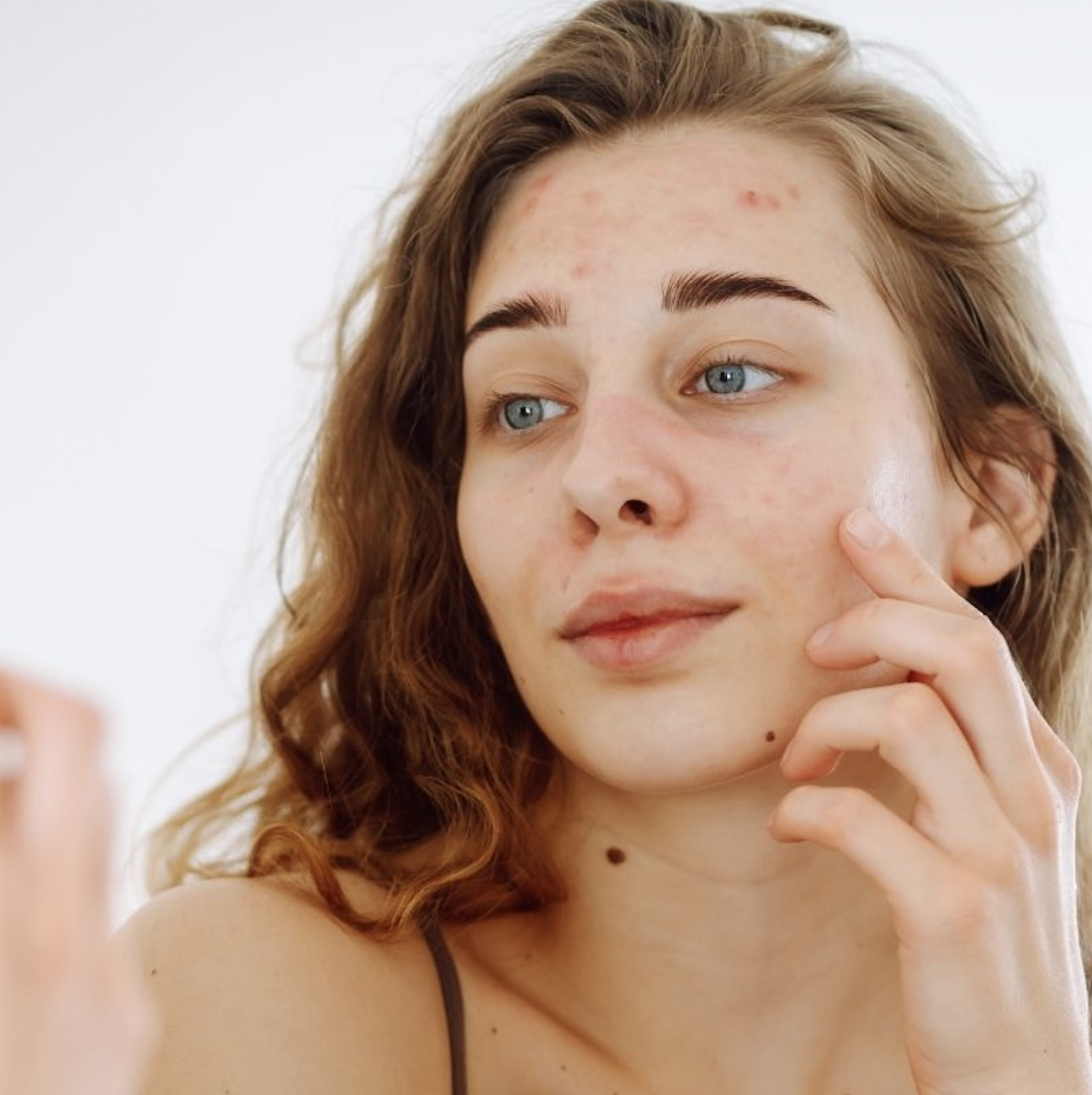 tipos de acne