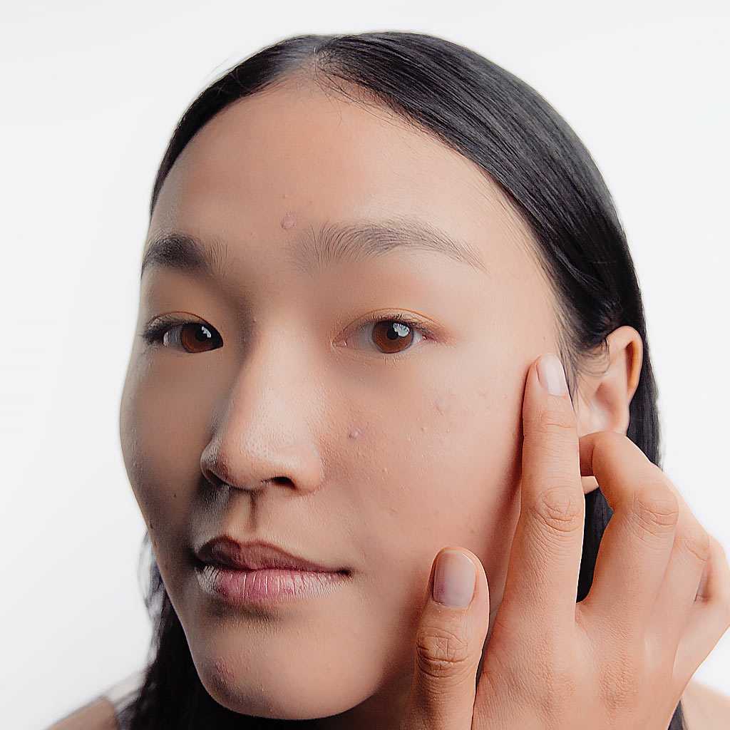 Imagen de una piel con acne