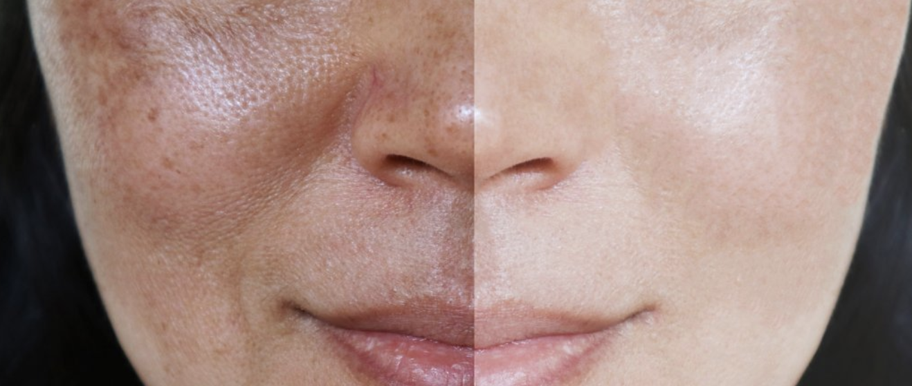 tratamiento reduce manchas