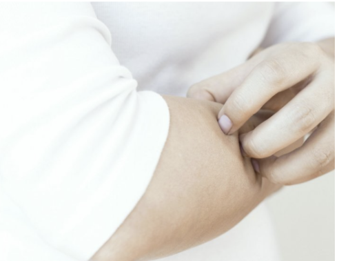 Dermatitis atópica