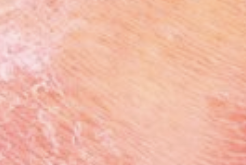 Dermatitis atópica