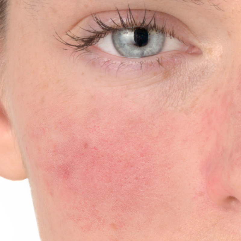 Síntomas de rosácea, enrojecimiento en las mejillas y la nariz