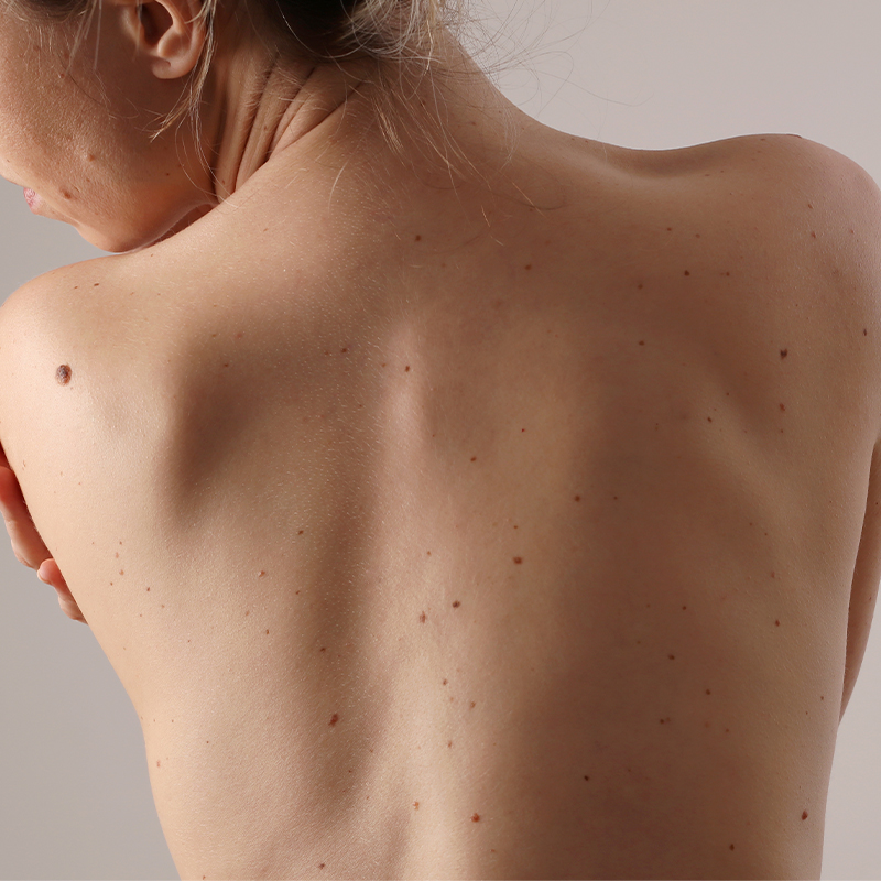 Espalda de mujer sin cicatrices