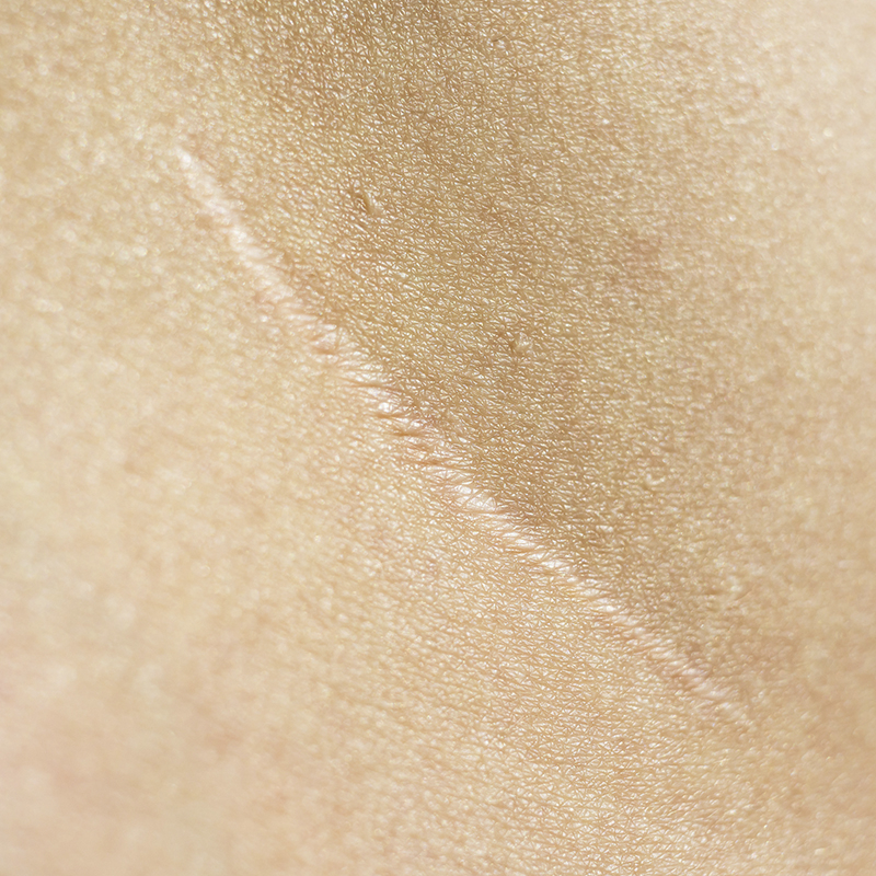 piel debilitada e irritada primer plano de la cicatriz