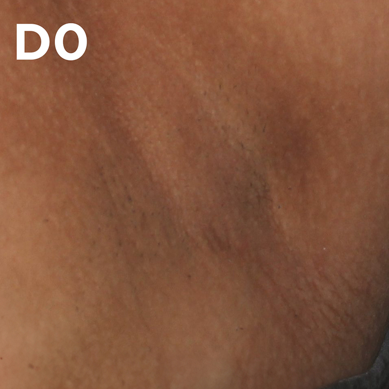 Clínicamente probado y aprobado en manchas oscuras