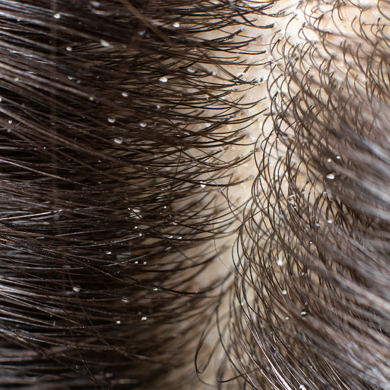 Caspa en el cabello