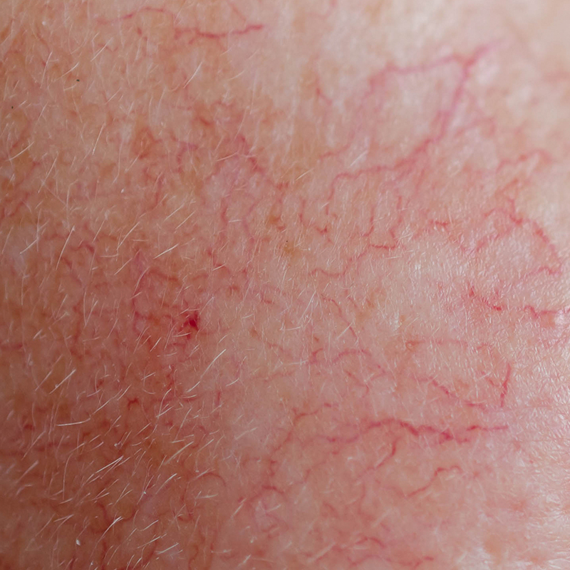 Primer plano de la piel del rostro que muestra enrojecimiento persistente