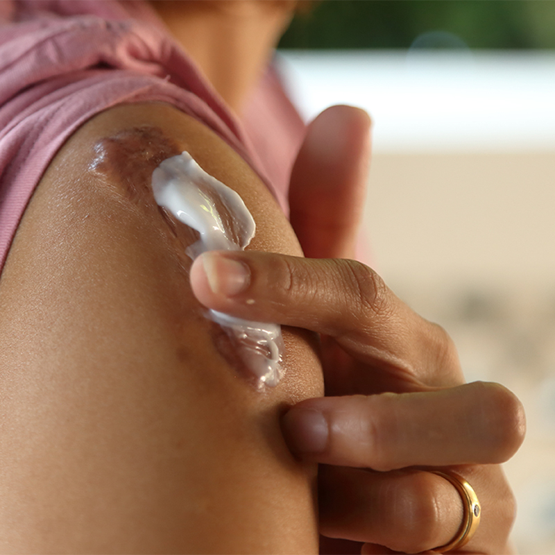 piel debilitada e irritada aplicando crema a la cicatriz