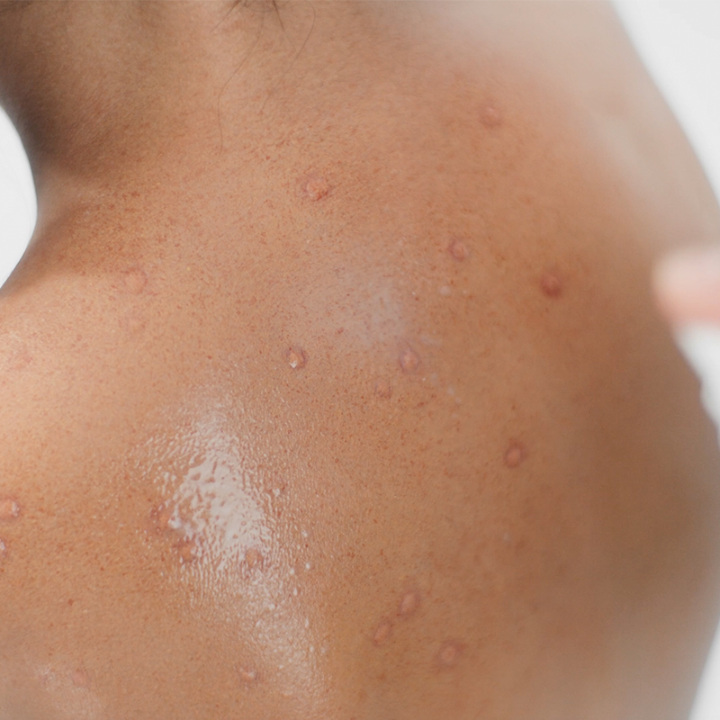 Espalda de mujer con cicatrices de varicela