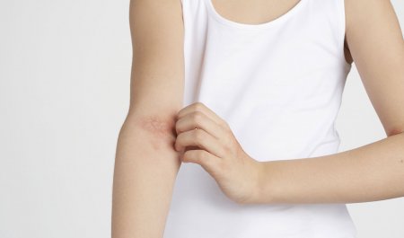 Dermatitis atópica en adultos