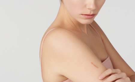 BIODERMA - mujer con cicatrices piel dañada 