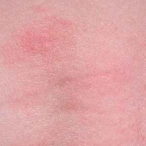 Piel con eczema