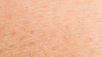 problemas de piel seca en niños