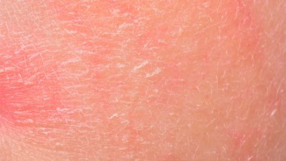 Toda la información sobre psoriasis y la seborreica |