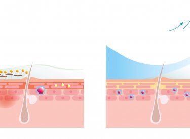 graphic representation of the cleansing effect of anti-acne cleansing products on dirt, perspiration and the effects of pollution
