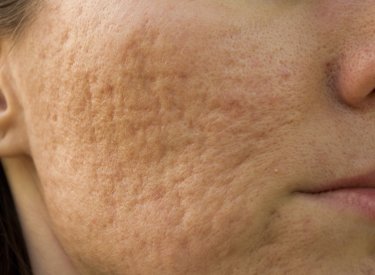 Cómo eliminar las marcas cicatrices del acné?