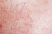 Desaparecido Regularmente cicatriz Piel con enrojecimiento y vasos visibles | Sensibio | BIODERMA